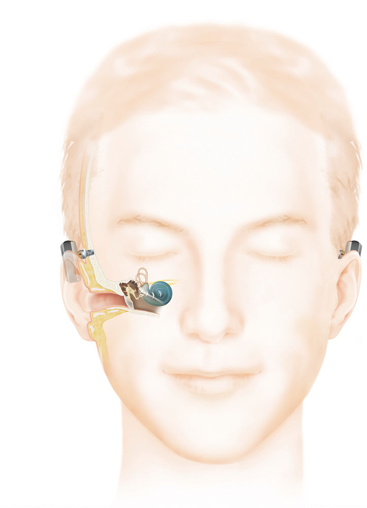 Bone anchored hearing aid (Baha)